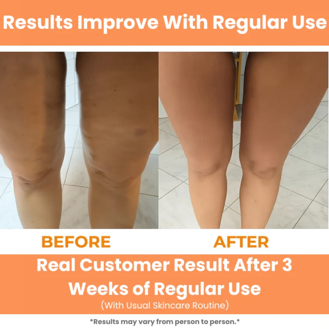 Round Ring Anti-Cellulite Deep Tissue Massage Roller – 14-Wheel Full-Body Massager for Smoother, Firmer Skin